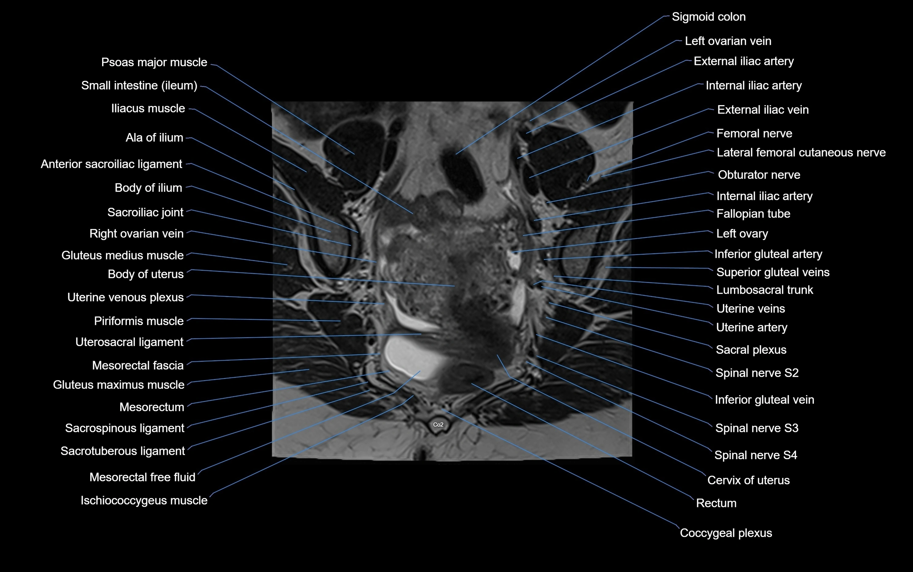 MRI sacroiliac joint coronal cross sectional anatomy  radiology  image-img-00001-00005.webp